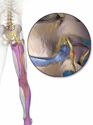 areas of possible sciatica pain
